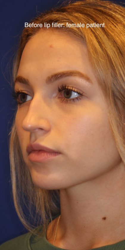 Lip Filler Before & After Patient #13833
