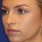 Lip Filler Before & After Patient #13833