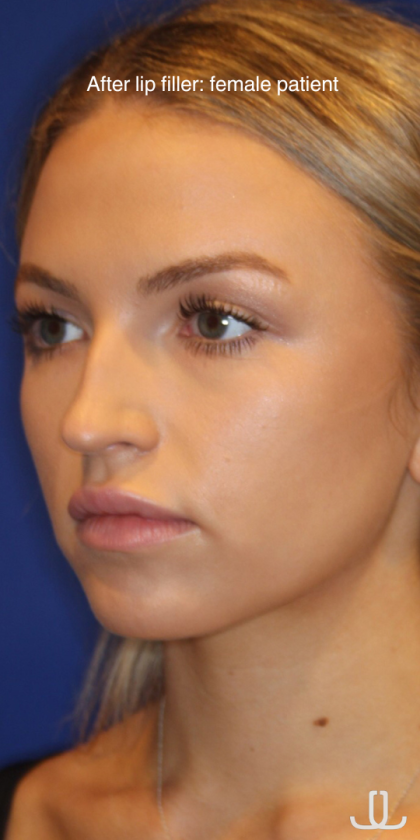 Lip Filler Before & After Patient #13833