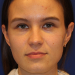 Dermal Fillers Before & After Patient #13859