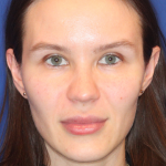 Dermal Fillers Before & After Patient #13859