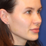 Dermal Fillers Before & After Patient #13859