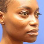 Dermal Fillers Before & After Patient #15575