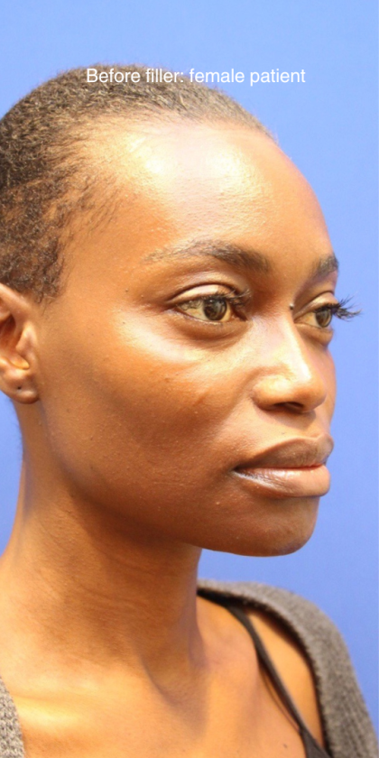 Dermal Fillers Before & After Patient #15575