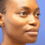 Dermal Fillers Before & After Patient #15575