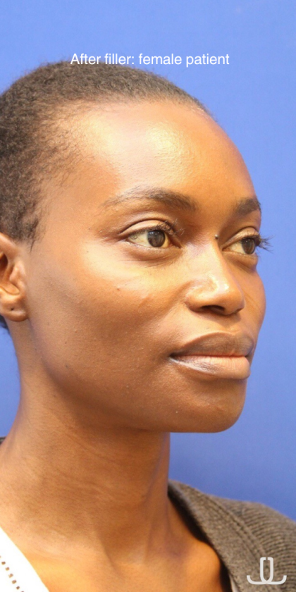 Dermal Fillers Before & After Patient #15575