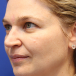 Liquid Facelift Before & After Patient #15794
