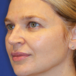 Liquid Facelift Before & After Patient #15794