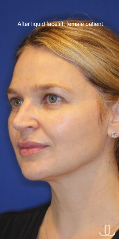 Liquid Facelift Before & After Patient #15794