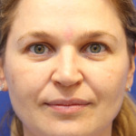 Liquid Facelift Before & After Patient #15794
