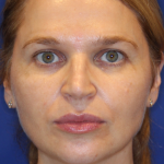 Liquid Facelift Before & After Patient #15794