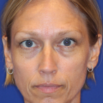 Liquid Facelift Before & After Patient #15793