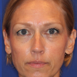 Liquid Facelift Before & After Patient #15793