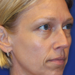 Liquid Facelift Before & After Patient #15793