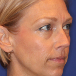 Liquid Facelift Before & After Patient #15793