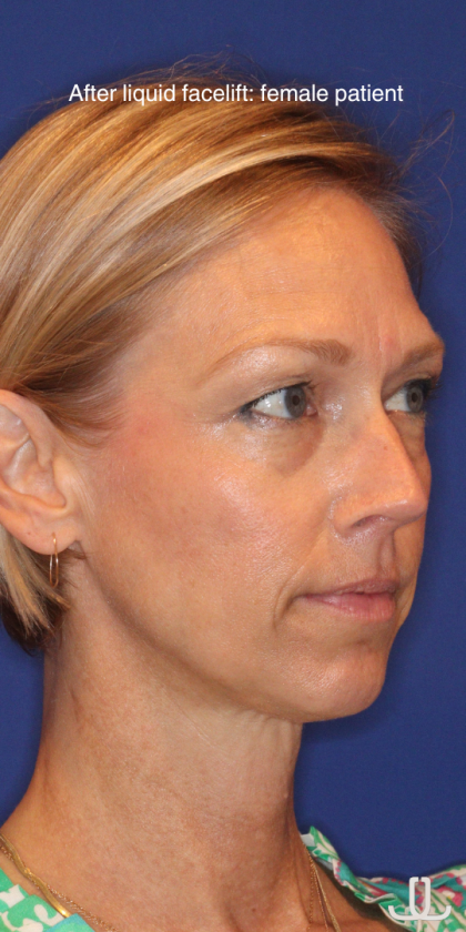 Liquid Facelift Before & After Patient #15793