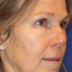 Liquid Facelift Before & After Patient #15792