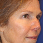 Liquid Facelift Before & After Patient #15792