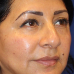 Liquid Facelift Before & After Patient #15791
