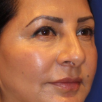 Liquid Facelift Before & After Patient #15791