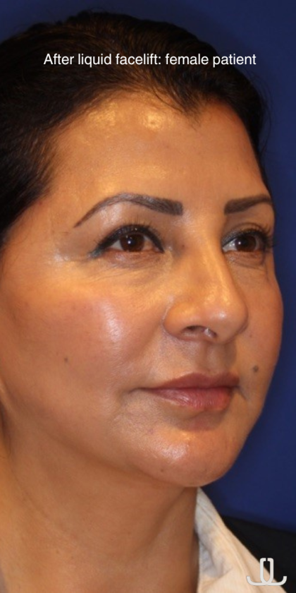 Liquid Facelift Before & After Patient #15791