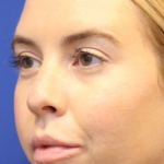Liquid Facelift Before & After Patient #15790