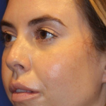 Liquid Facelift Before & After Patient #15790