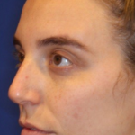 Liquid Facelift Before & After Patient #15789