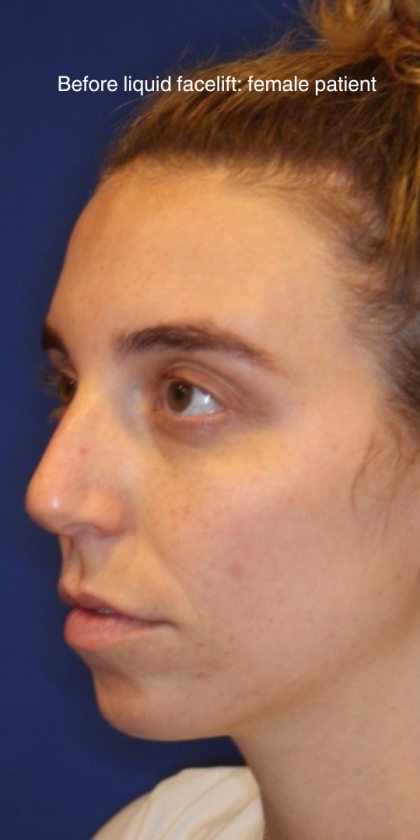 Liquid Facelift Before & After Patient #15789