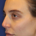 Liquid Facelift Before & After Patient #15789
