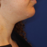 Neck Liposuction Before & After Patient #15836