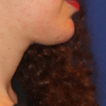 Neck Liposuction Before & After Patient #15836
