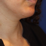 Neck Liposuction Before & After Patient #15836