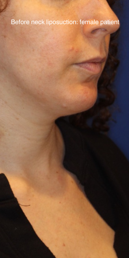 Neck Liposuction Before & After Patient #15836