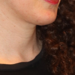 Neck Liposuction Before & After Patient #15836