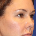 Botox & Wrinkle Relaxers Before & After Patient #15130