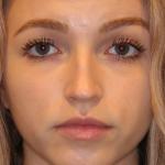Botox & Wrinkle Relaxers Before & After Patient #15131