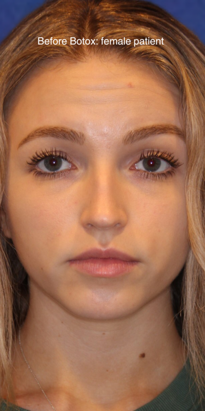 Botox & Wrinkle Relaxers Before & After Patient #15131