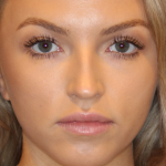 Botox & Wrinkle Relaxers Before & After Patient #15131