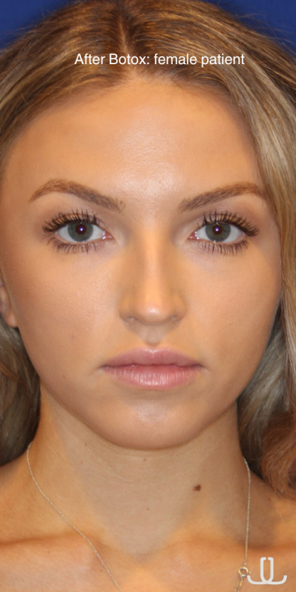 Botox & Wrinkle Relaxers Before & After Patient #15131