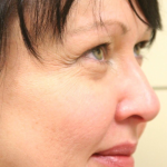 Botox & Wrinkle Relaxers Before & After Patient #15137