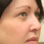 Botox & Wrinkle Relaxers Before & After Patient #15137