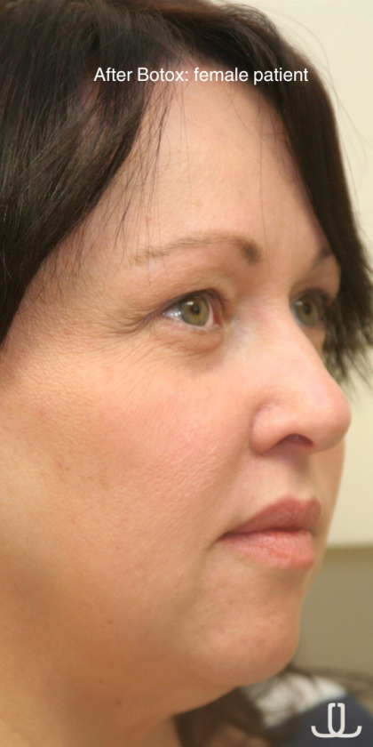 Botox & Wrinkle Relaxers Before & After Patient #15137