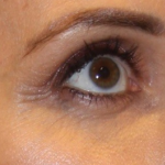 Botox & Wrinkle Relaxers Before & After Patient #15138