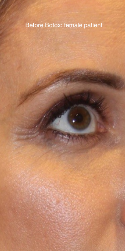 Botox & Wrinkle Relaxers Before & After Patient #15138