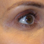 Botox & Wrinkle Relaxers Before & After Patient #15138