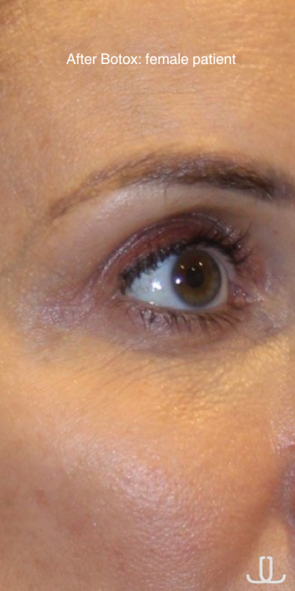 Botox & Wrinkle Relaxers Before & After Patient #15138
