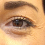 Botox & Wrinkle Relaxers Before & After Patient #15140