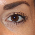 Botox & Wrinkle Relaxers Before & After Patient #15140