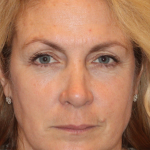 Botox & Wrinkle Relaxers Before & After Patient #15141